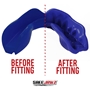 SafeJawz Intro Series Blue Mouthguard - Before/After 