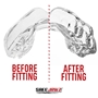 SafeJawz Intro Series Clear Mouthguard - Before/After 