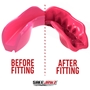 SafeJawz Intro Series Pink Mouthguard - Before/After 